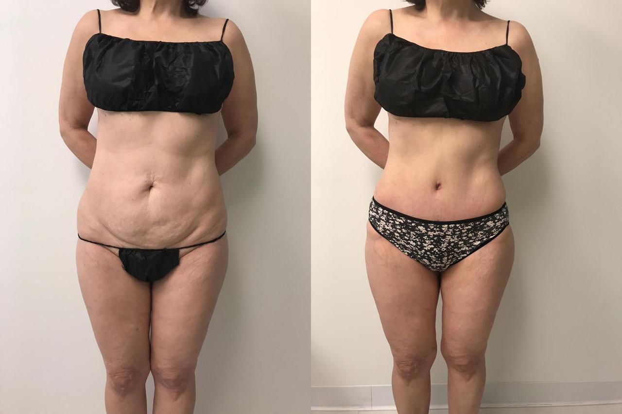 Pacific Lipo Newport Beach