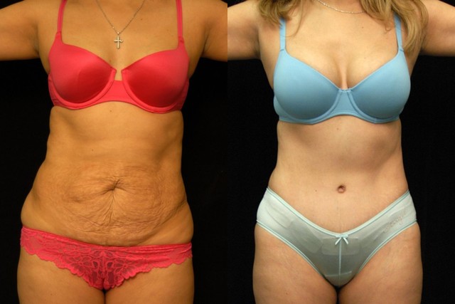 Liposuction Newport Beach