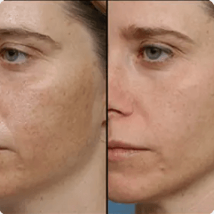 Light Chemical Peel