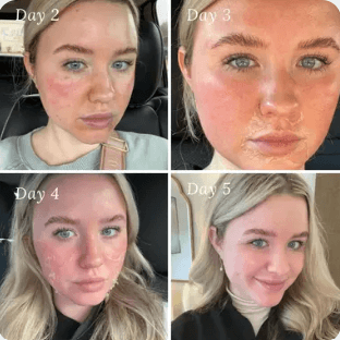 Medium Peel