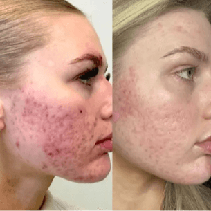 Acne- Focus Peels