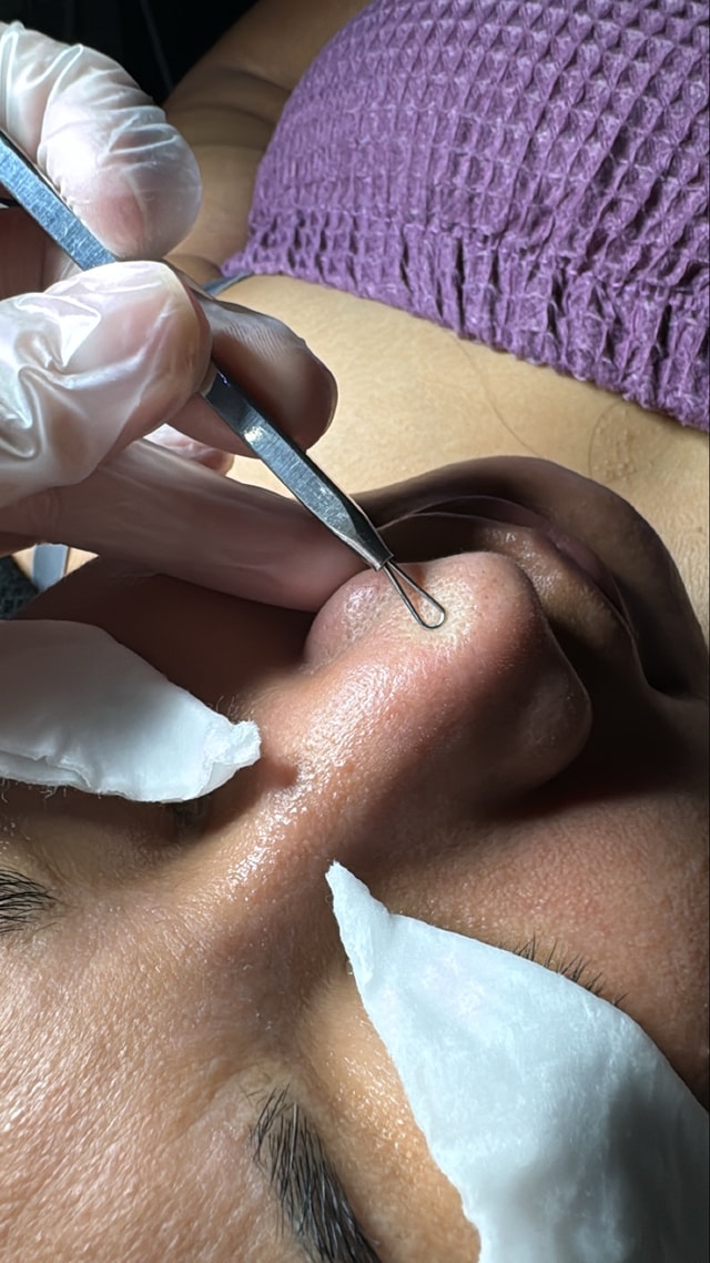 Extractions