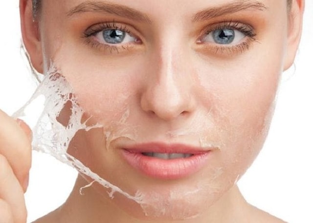 Acne Scar Chemical Peel + Exosomes