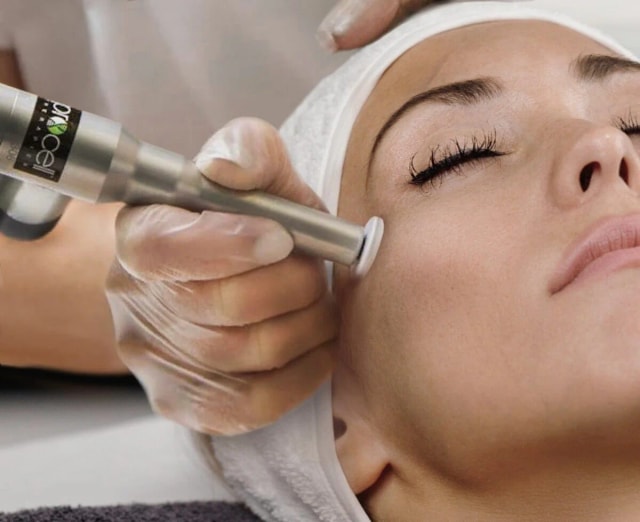 Acne Scar Microchanneling + Salmon DNA PDRN