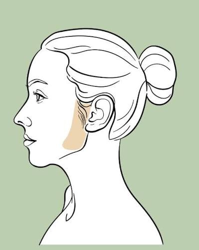 Sideburns (patillas) Laser Hair Removal