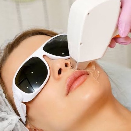 Upper lip Laser Hair Removal