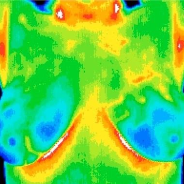Thermal Insight Thermography