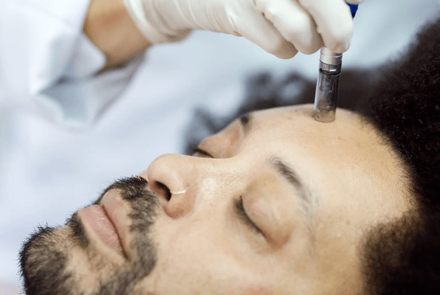 Microneedling